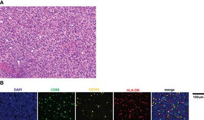 Tumor-Associated Macrophages Correlate With Prognosis in Medulloblastoma